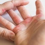 Stigma dan Keterbatasan Akses Kesehatan: Tantangan Penanggulangan Kusta di Sampang