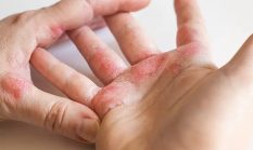 Stigma dan Keterbatasan Akses Kesehatan: Tantangan Penanggulangan Kusta di Sampang